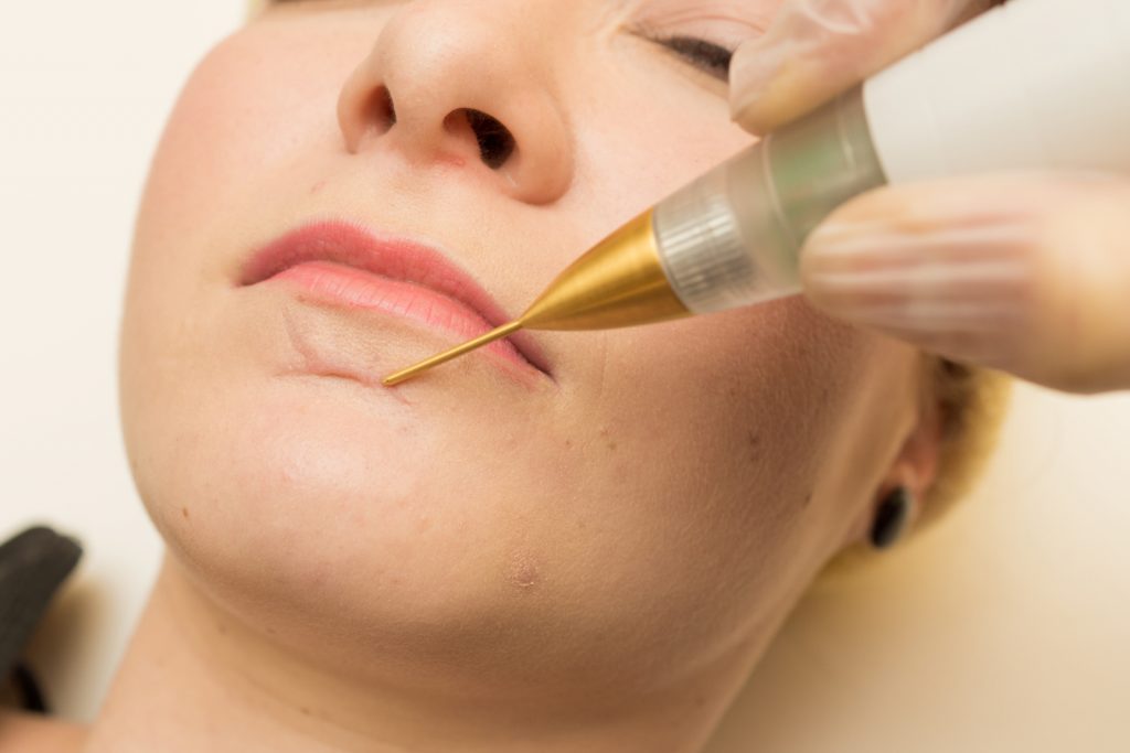 Plasma lift